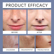 OUHOE Facial Blackspot Cream for Freckles Lightening and Skin Brightening Moisturizing Nourishing Protection