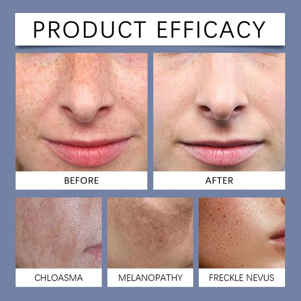 OUHOE Facial Blackspot Cream for Freckles Lightening and Skin Brightening Moisturizing Nourishing Protection